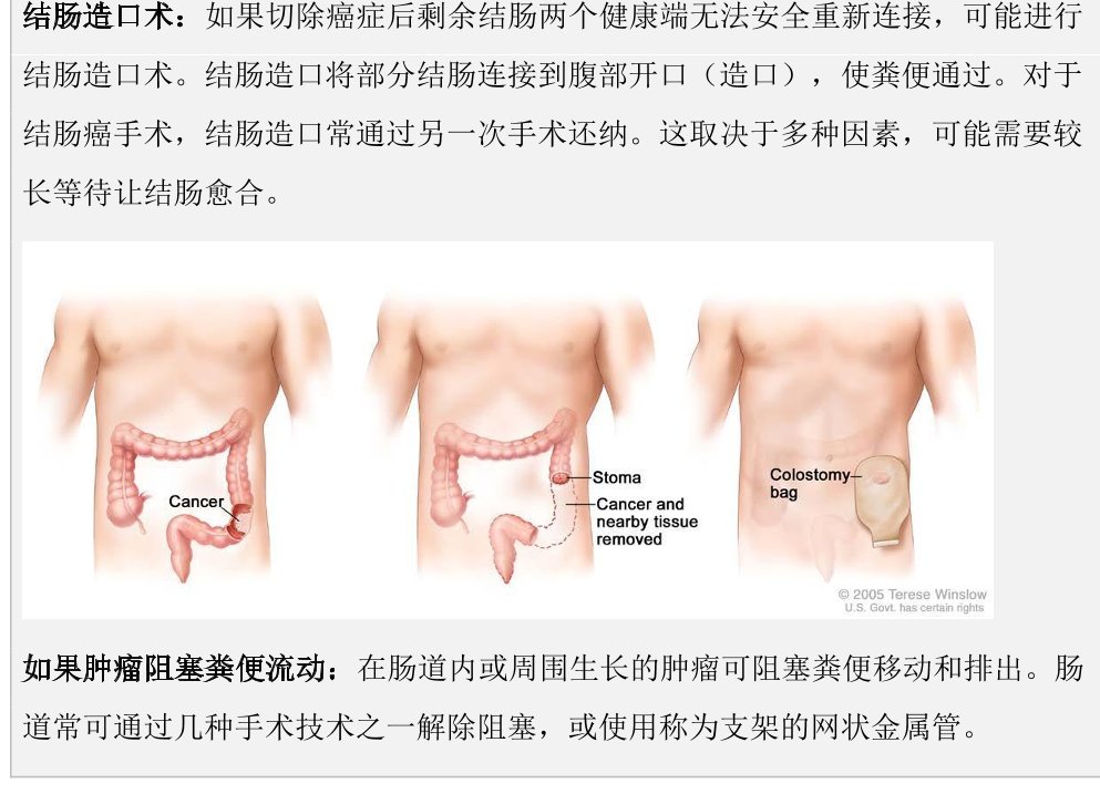 NCCN 患者指南结肠癌示意图